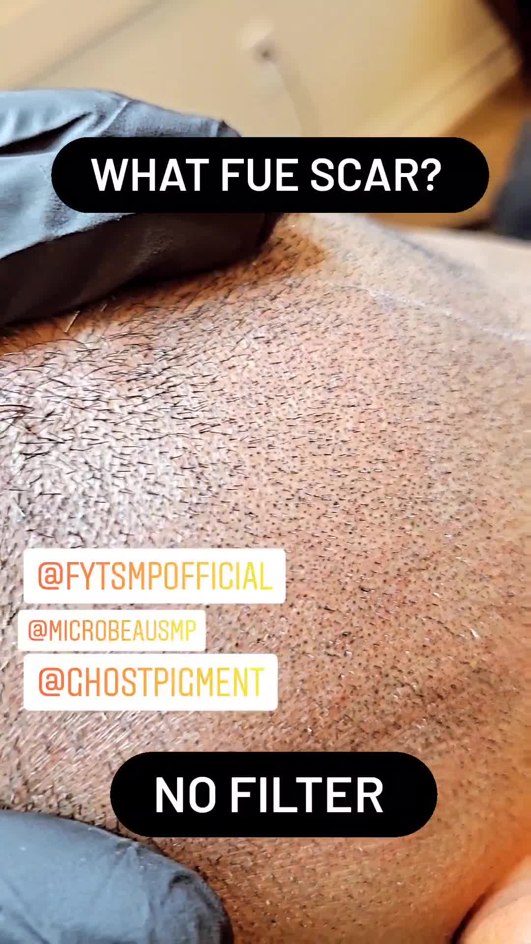 Scalpmicropigmentation Toronto hair Loss clinic